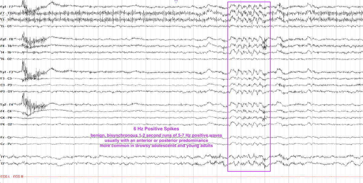 14Hz & 6Hz Positive Spikes - Neuro Pathway